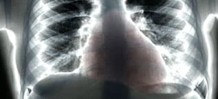 röntgenbild herz und lunge